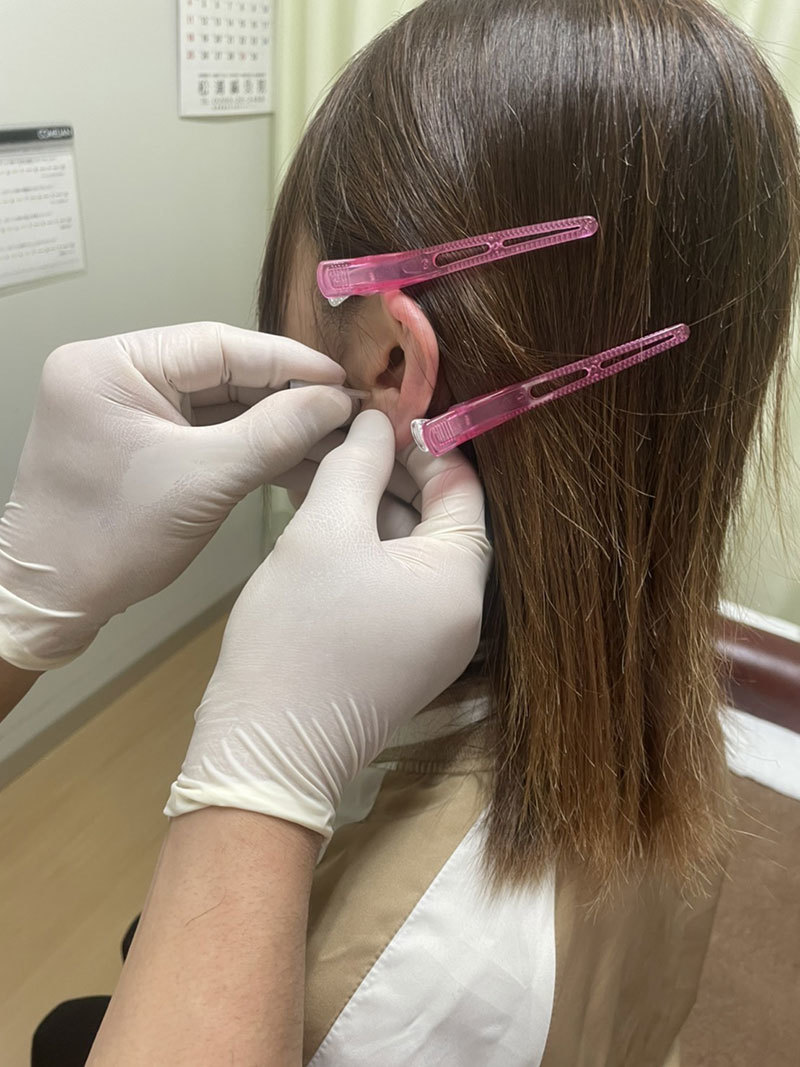 耳ばり　ASP鍼　チタン鍼　BFA戦場鍼