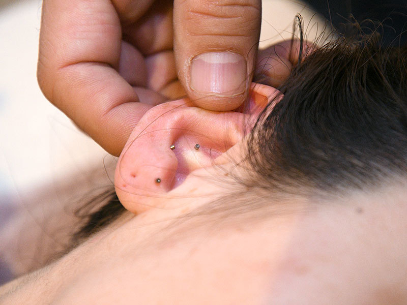 耳ばり　ASP鍼　チタン鍼　BFA戦場鍼