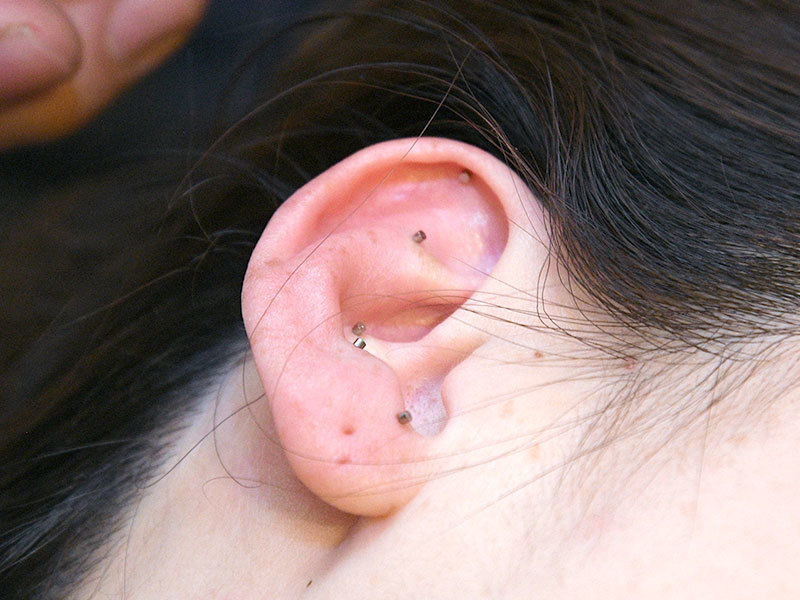 耳ばり　ASP鍼　チタン鍼　BFA戦場鍼