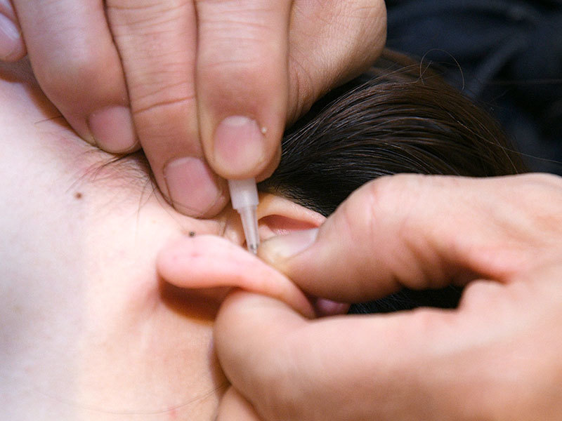 耳ばり　ASP鍼　チタン鍼　BFA戦場鍼