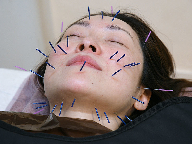 美容鍼/耳鍼/美顔筋トレ