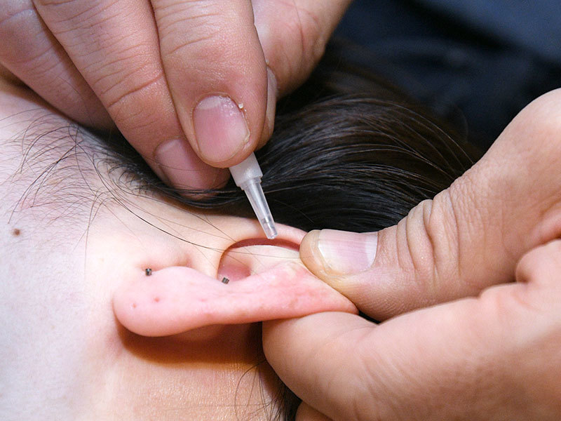 耳ばり　ASP鍼　チタン鍼　BFA戦場鍼